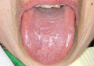 Sjogren症候群患者さんの舌、平滑舌、溝状舌の画像