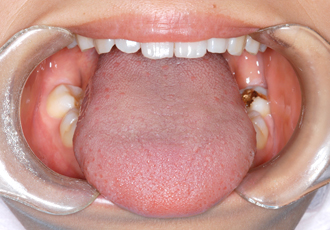 正常な舌の画像