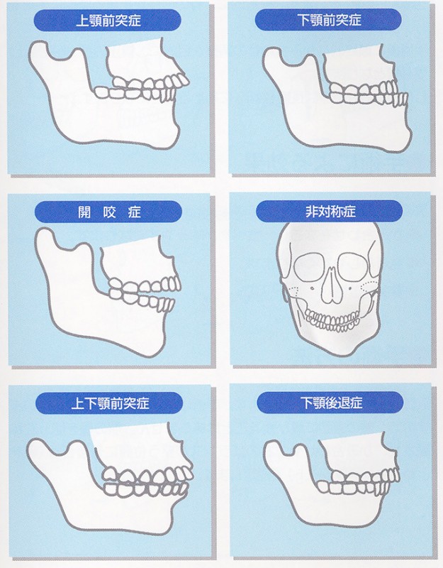 図1　顎変形症の分類