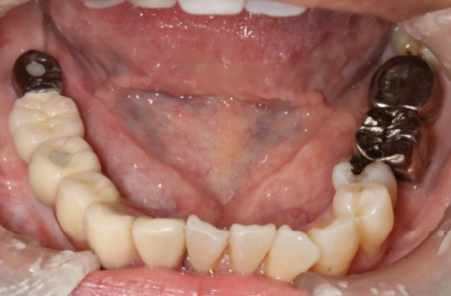 広範囲指示型補綴装置装着