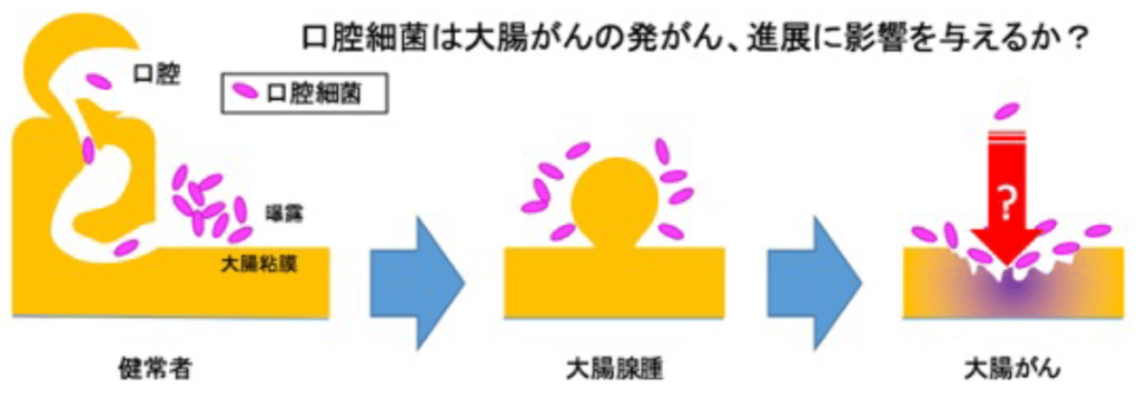 口腔における細菌・真菌マイクロバイオームと全身疾患への影響